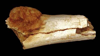 Oldest evidence of cancer discovered in foot bone