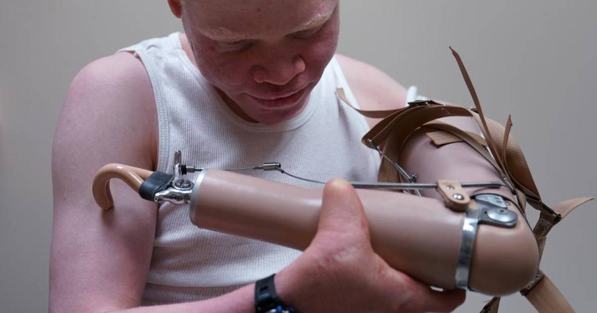 Albino children attacked for body parts get new limbs in America