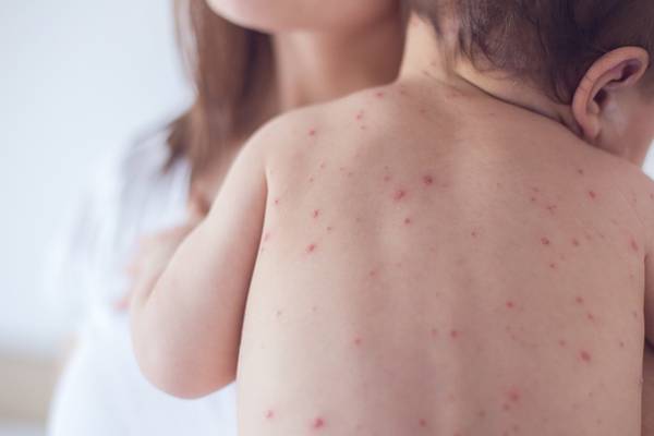 Measles warning as seven cases confirmed in Dublin and Meath