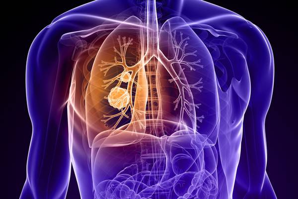 Less sympathy for those with lung cancer compared with other cancers