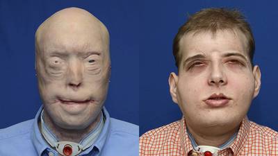Firefighter has world’s most extensive face transplant