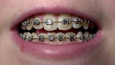Why are so many adults having braces put on their teeth?