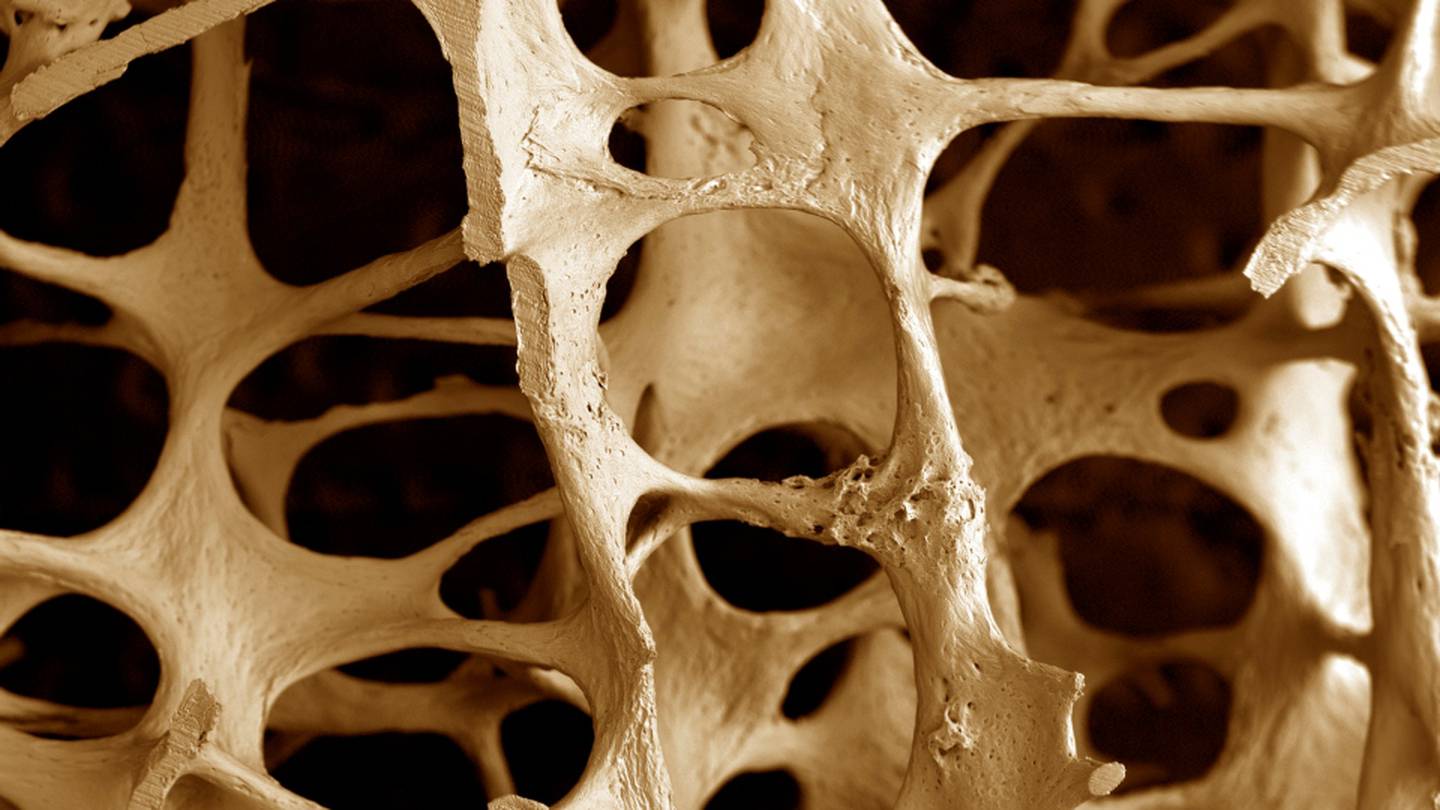 Костные ткани черепа. Остеопороз. Пористая кость. Костная ткань.