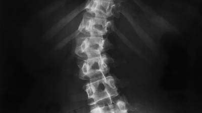 Irish children with faulty spinal support rods may need them removed