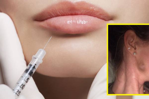 ‘Botched’ dermal filler leaves woman with physical and emotional scars