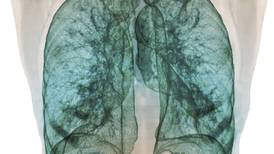 AI took a test to detect lung cancer. It got an A