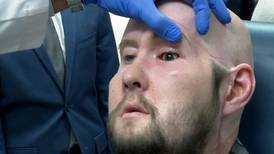 'A huge step forward': US surgeons announce first-ever whole-eye transplant in a human