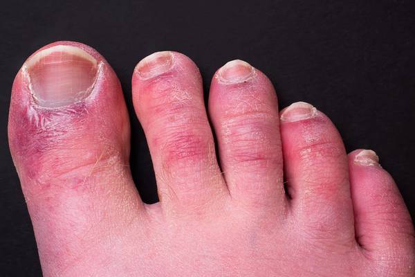 ‘Covid toes’ may be side effect of immune system response, study finds