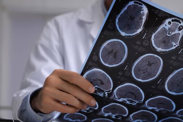Advances in MRI may open window for treating neurodegenerative diseases