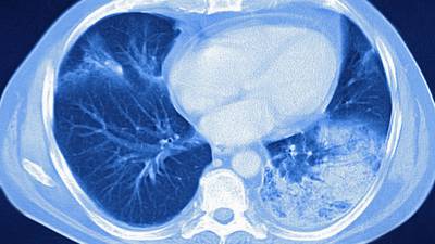 Coronavirus: What happens to people’s lungs if they get Covid-19?