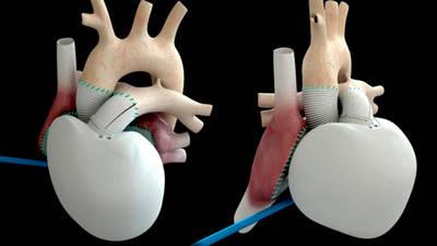 Patient fitted with artificial heart ‘doing well’
