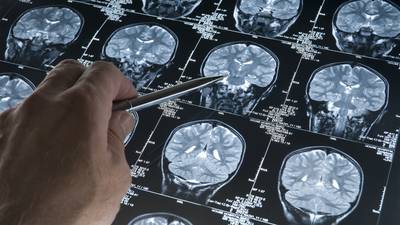 Brainwave data sheds flickering light on Alzheimer’s affliction