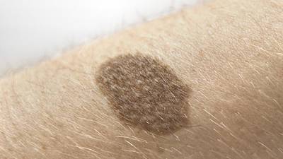 New class of drug targets skin cancer