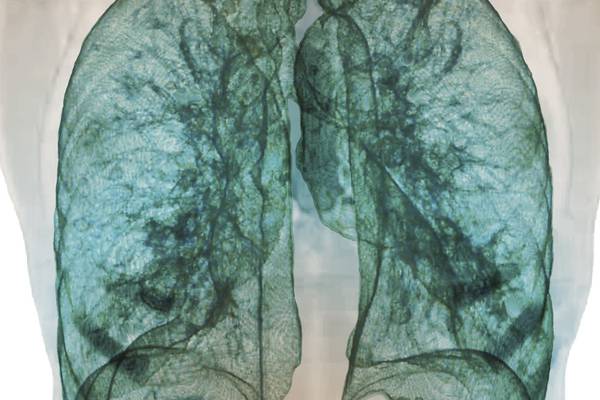 AI took a test to detect lung cancer. It got an A