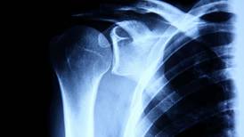 Irish medtech firm seeks €15m for bone-repair technology