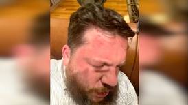 Long-term Navalny aide says hammer attack was 'classic gangster hello from Putin'