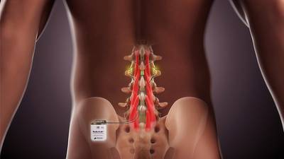 Mainstay Medical targets US back pain market