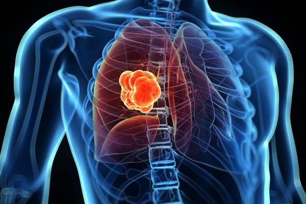 New drug approved for advanced lung cancer by HSE