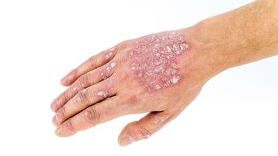 How to make life easier for Psoriasis sufferers