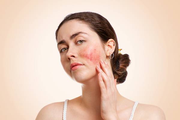 Rosacea: What is it and how can you manage it?