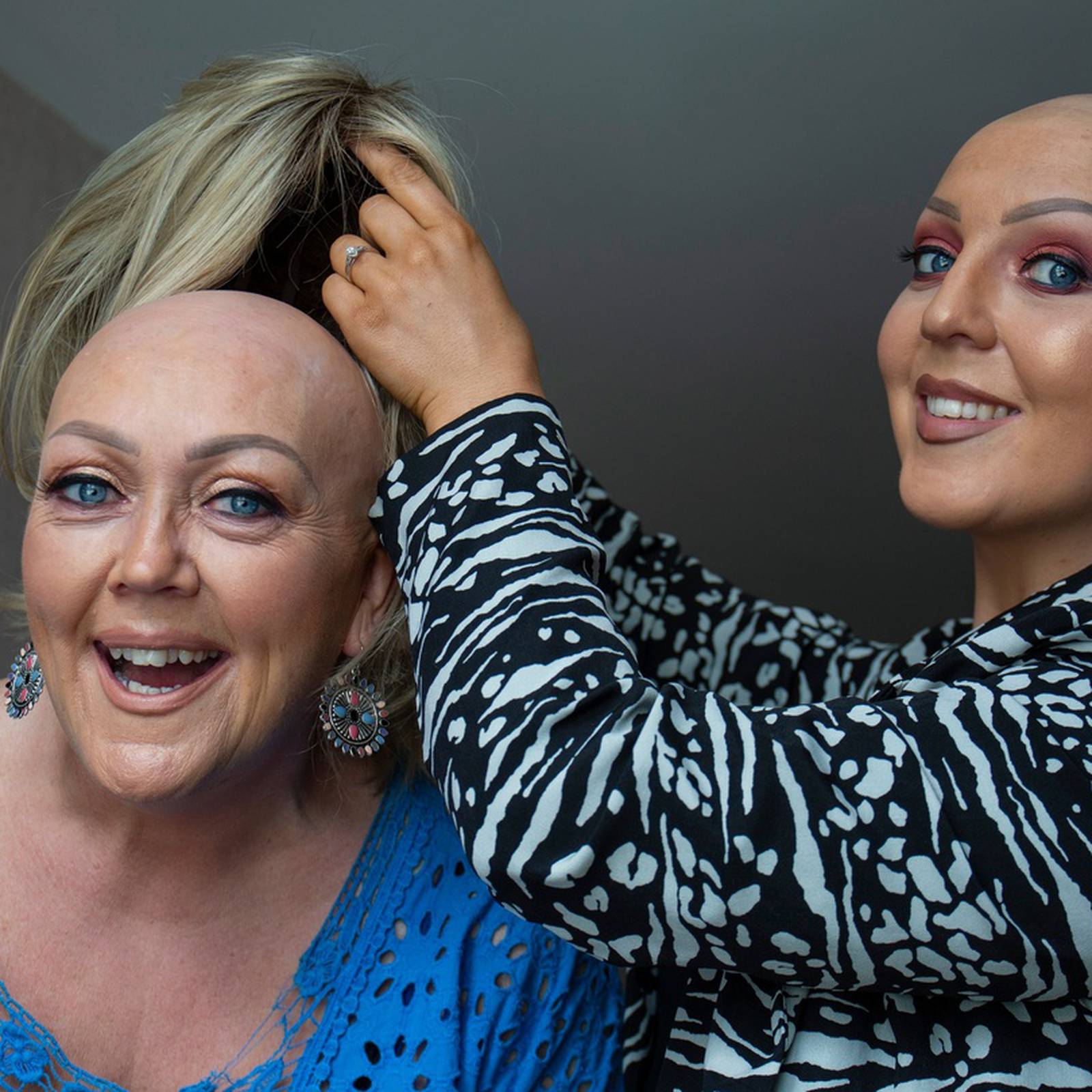 Alopecia: 'I couldn't bear the thought of her losing her hair' – The Irish  Times