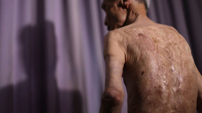Sumiteru Taniguchi shows his back with scars of burns from the atomic bomb explosion, during an interview at his office in Nagasaki, southern Japan in 2015. File photograph: Eugene Hoshiko/AP