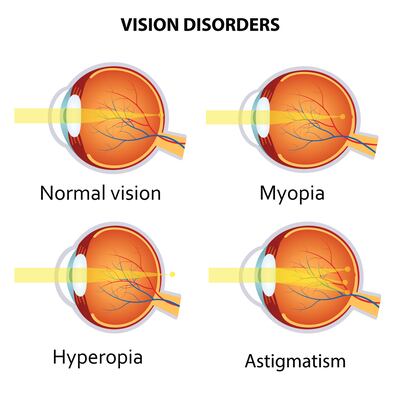 Short-sightedness (myopia) is when close-up objects look clear but distant objects are blurry. Far-sightedness (hyperopia) is the opposite. 

