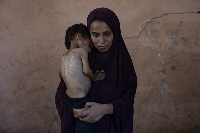 Two-year-old Yazan Abu Foul, held by his mother Naima, is suffering from severe malnutrition as a result of Israel's campaign in Gaza. Photograph: Haitham Imad