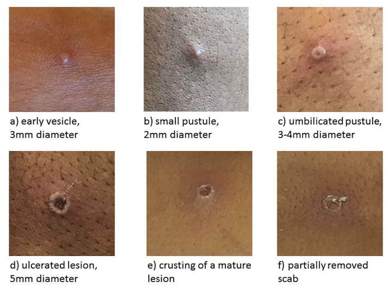 The stages of Monkeypox. Photograph: UK Health Security Agency/PA