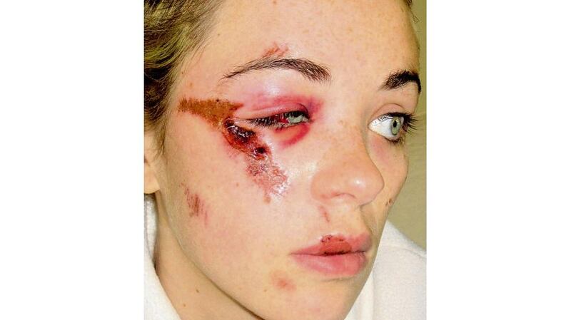The effects of a fall during one of Yvonne Brennan's seizures. photograph: brenda fitzsimons