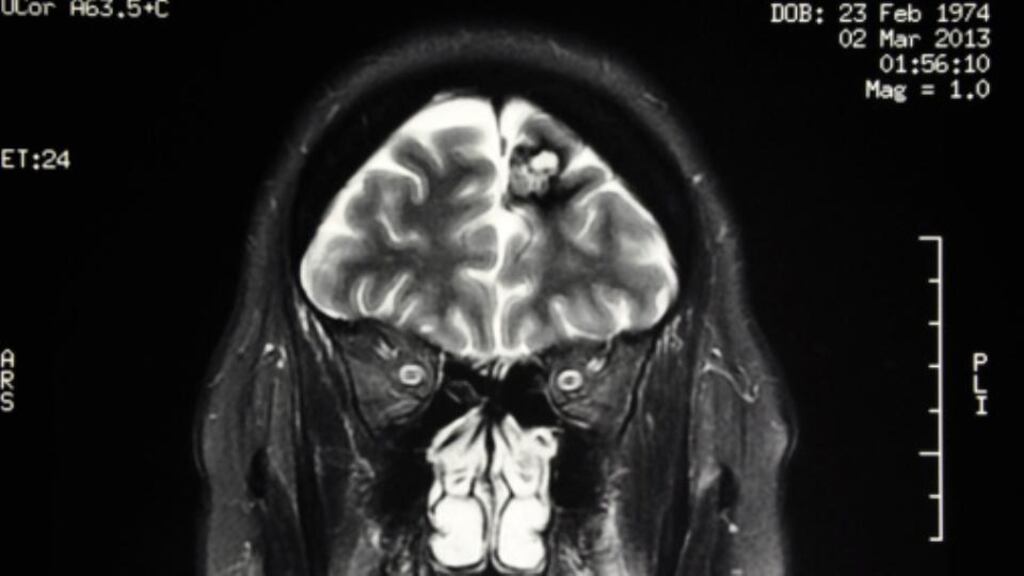The first test to determine the chance of a person suffering a stroke or developing heart disease within 10 years in any country in the world has been developed by scientists