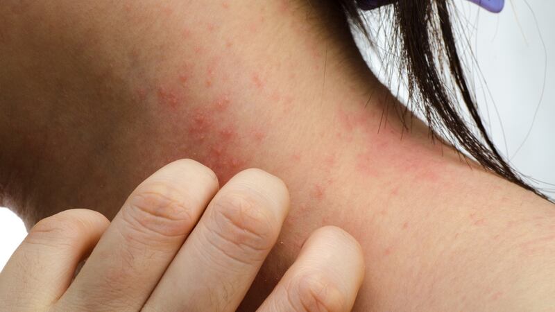In kids, eczema typically affects the backs of knees and elbow creases. Adults often find hands, eyelids and skin creases affected.