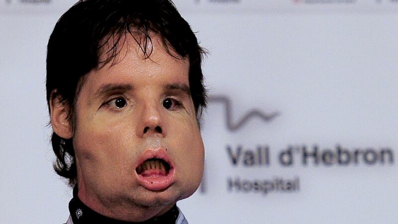 Oscar attends a press conference after undergoing a face transplant at Vall d’Hebron hospital in Barcelona, on July 26, 2010. Photograph: Josep Lago/AFP/Getty Images