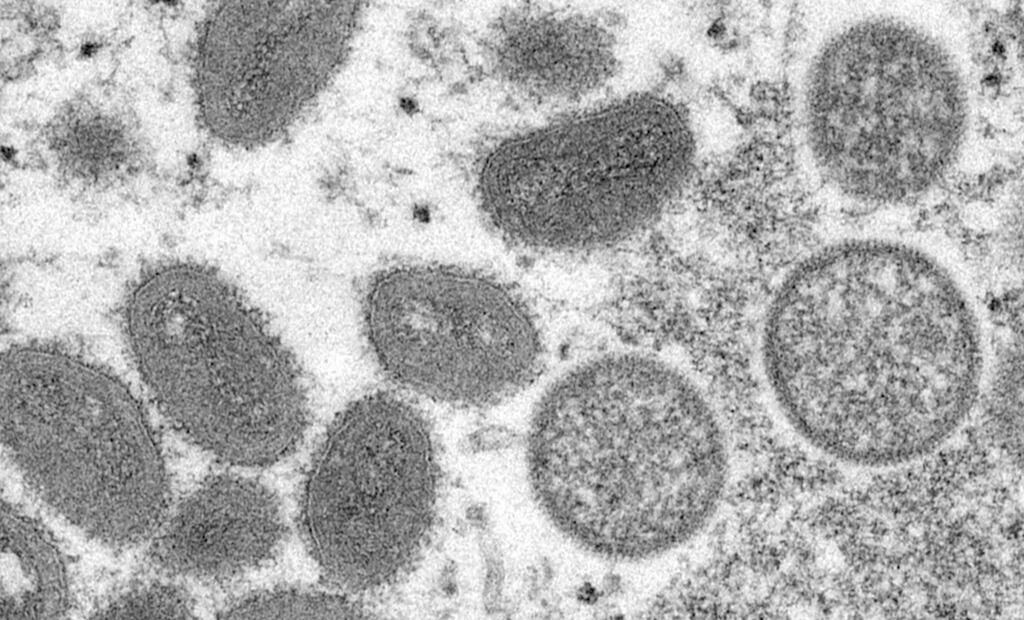 Unlike Covid-19, it is easily observed when somebody has it because those who are infected get a chickenpox-like rash on their hands and face.