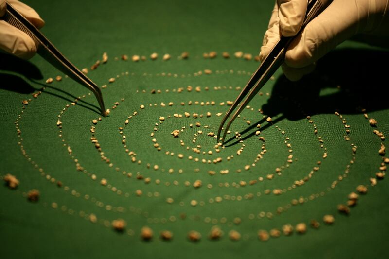 526 teeth: the tooth-like structures removed from the boy’s mouth. Photograph: P Ravikumar/Reuters
