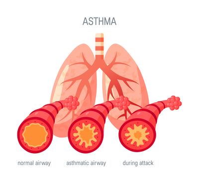 Taking medication correctly is key to managing the symptoms. Illustration: Getty Images