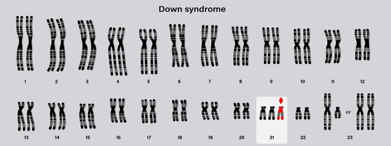 When 'miracle baby' Pippa was born in July 2023 her parents already knew she was coming with one extra copy of chromosome 21 in her body cells, a condition known as Down syndrome