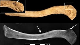 Archaeologists discover earliest example of human with cancer