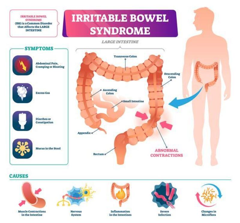 Irritable bowel syndrome  illustration.
