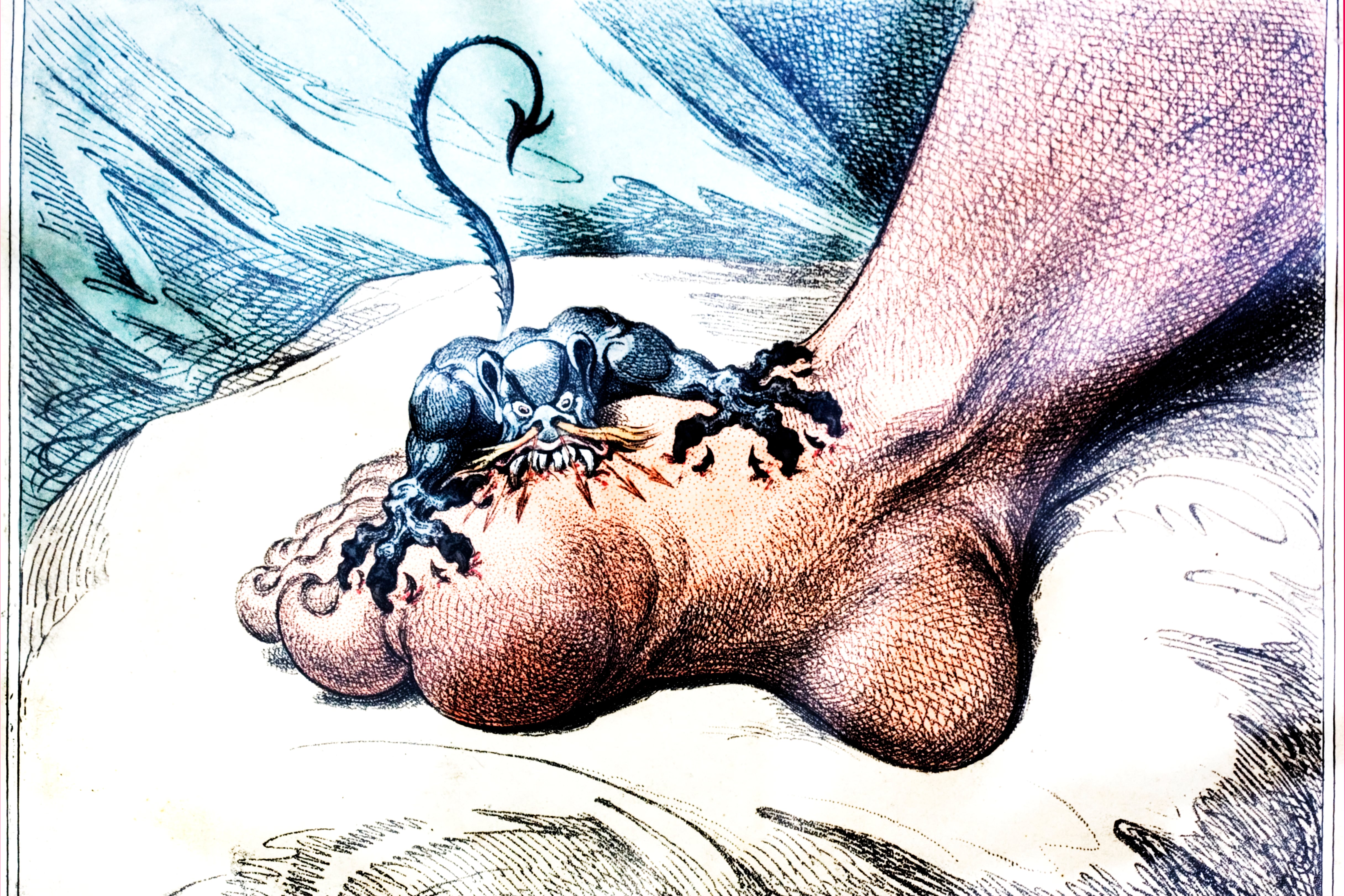 TikTok is wrong about gout: it isn’t about indulgence and excess