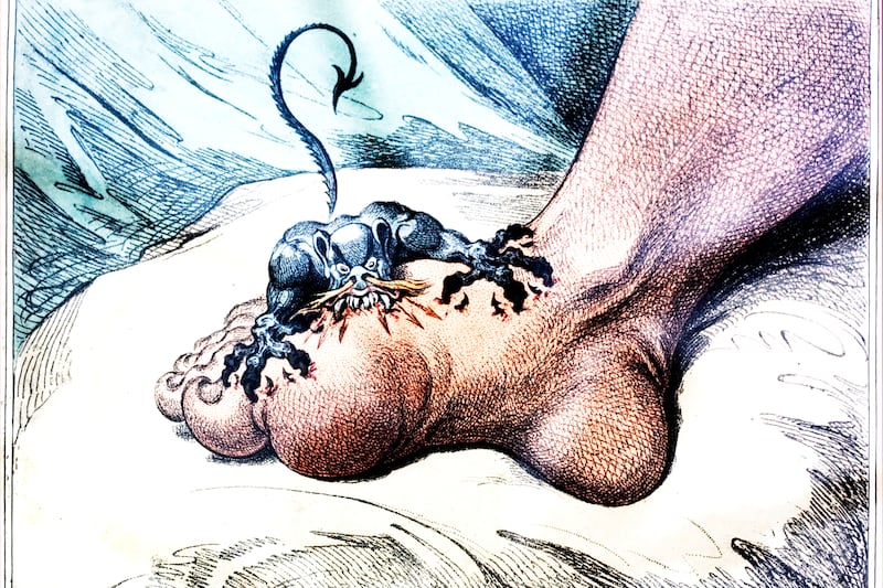 TikTok is wrong about gout: it isn’t about indulgence and excess