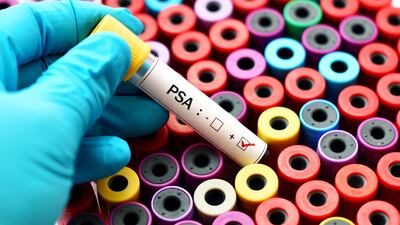 A PSA test can predict prostate cancer. Photograph: iStock