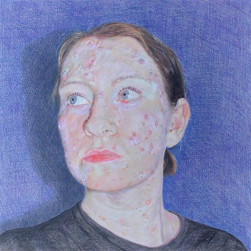 The Pox, by Emily McGardle