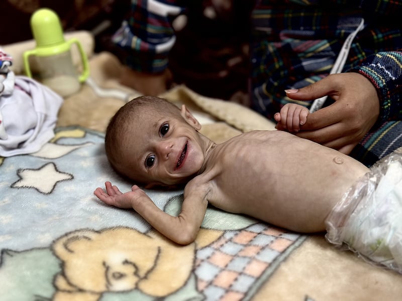 Five-month-old Siwar Ashour, one of hundreds of children diagnosed with malnutrition in Khan Yunis, Gaza on May 1st, 2025. Photo by Doaa Albaz/Anadolu via Getty Images