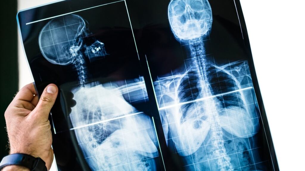 According to media reports, the HSE is considering sending scoliosis patients abroad for treatment under the National Treatment Purchase Fund. Photograph: iStock