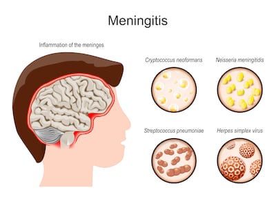Inflammation of the meninges. Illustration: iStock
