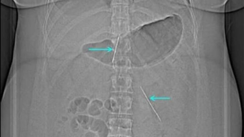 Another part of the X-ray, showing sewing needles lodged in the woman’s abdomen.