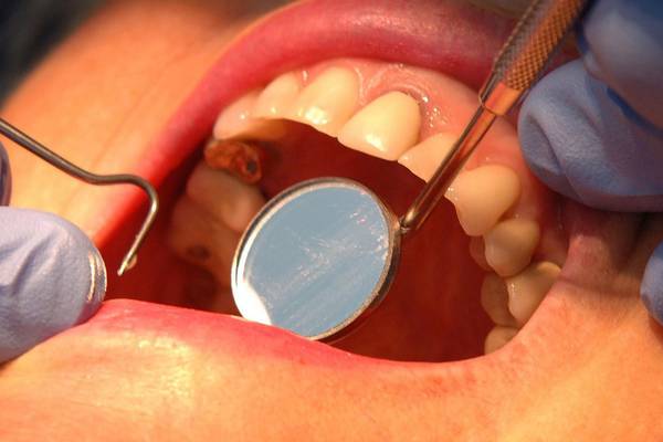 People with history of gum disease more likely to develop cancers – study