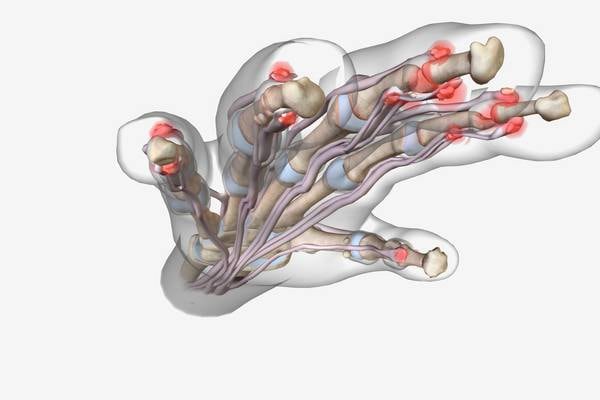 Understanding the links between psoriasis and psoriatic arthritis