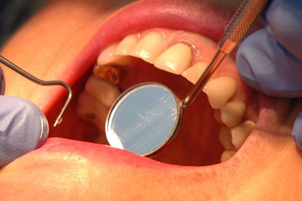 Use of mercury-based dental fillings to be phased out